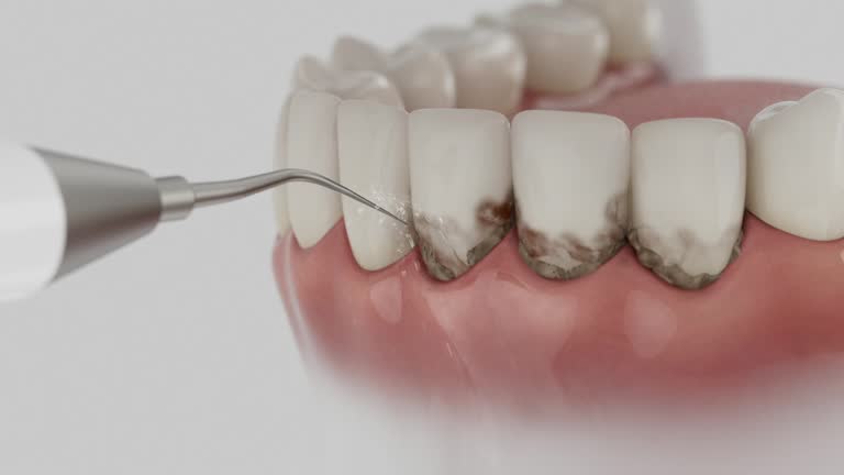 Trusted Wisdom Tooth Removal service in Beloit, OH - Dentist Open Now